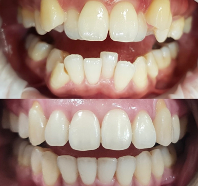 Orthodontics, before and after