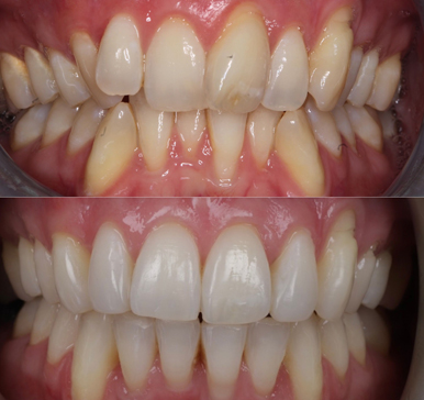 Orthodontics, before and after