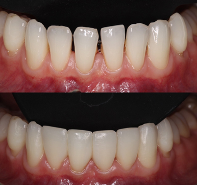 Composite bonding, before and after
