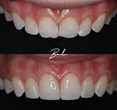 Composite bonding, before and after