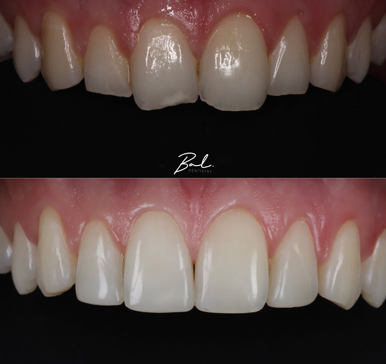 Composite bonding, before and after