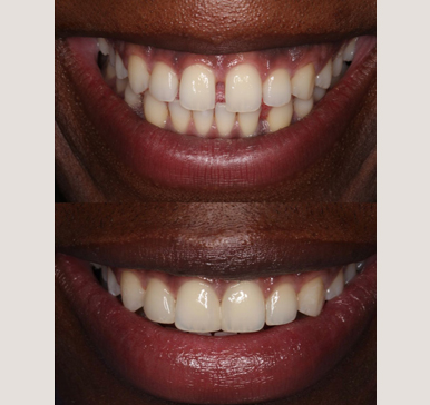 Composite bonding, before and after