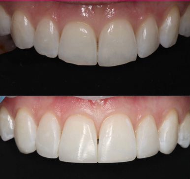Composite bonding, before and after