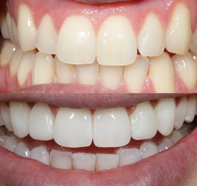 Composite bonding, before and after