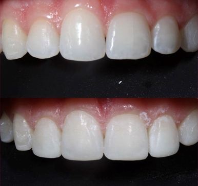 Composite bonding, before and after