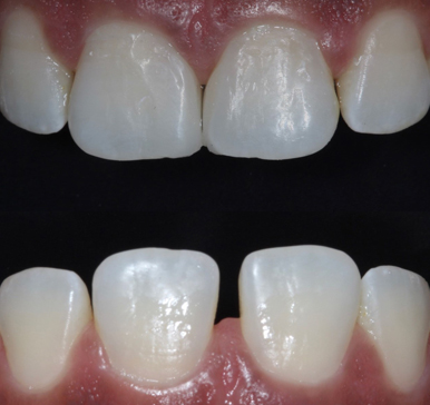 Composite bonding, before and after