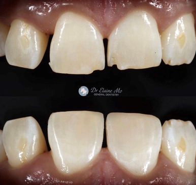 Composite bonding, before and after