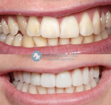 Composite bonding, before and after