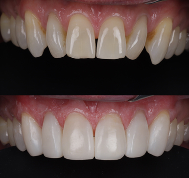 Composite bonding, before and after