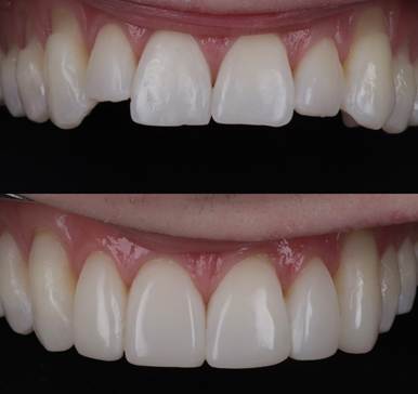 Composite bonding, before and after