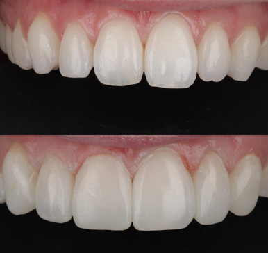 Composite bonding, before and after