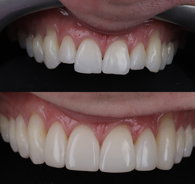Composite bonding, before and after