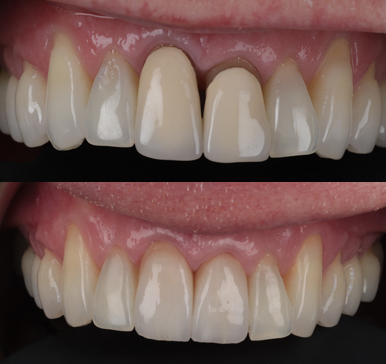Crowns, before and after