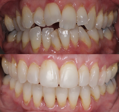Invisalign, before and after