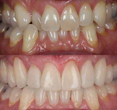 Invisalign, before and after