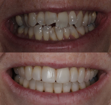 Invisalign, before and after