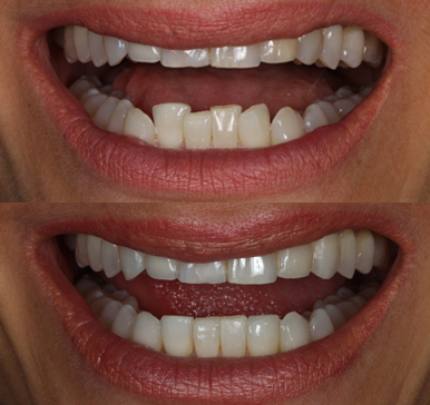 Invisalign, before and after