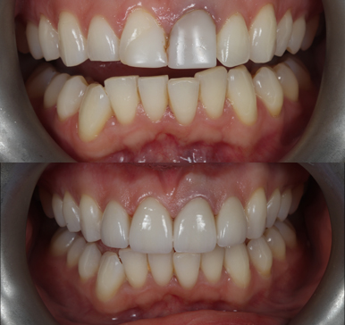 Porcelain veneers, before and after