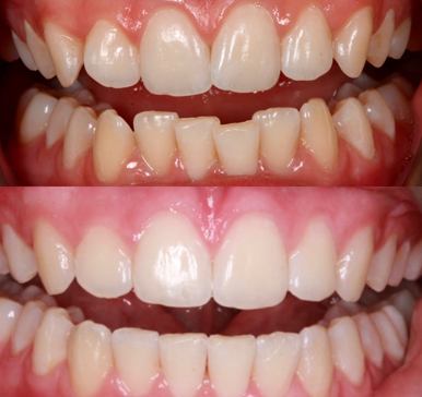 Orthodontics, before and after