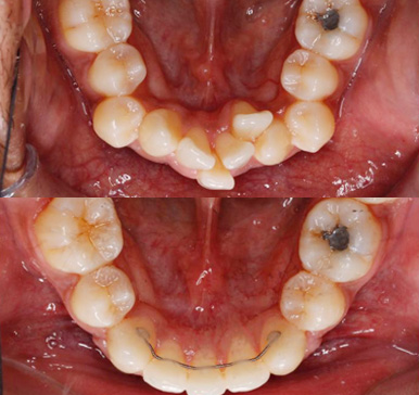 Orthodontics, before and after