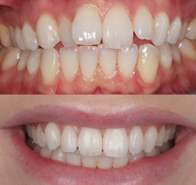 Orthodontics, before and after