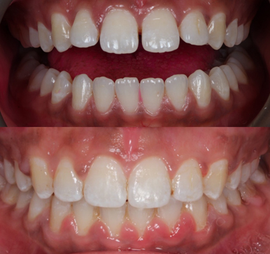 Orthodontics, before and after