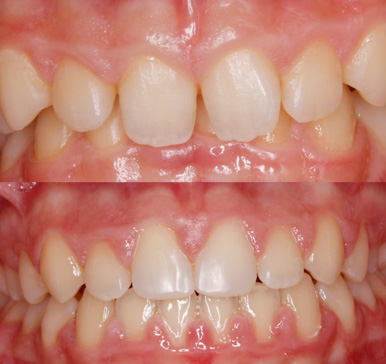 Orthodontics, before and after