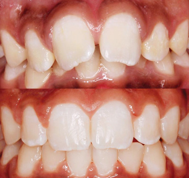 Orthodontics, before and after