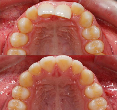 Orthodontics, before and after