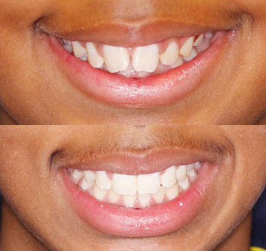 Orthodontics, before and after