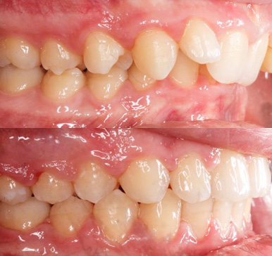 Orthodontics, before and after