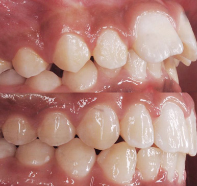 Orthodontics, before and after